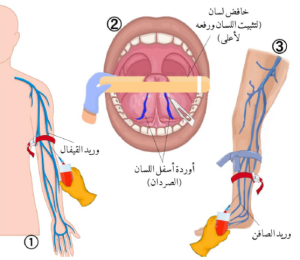 دبلوم العلاج بالفصد